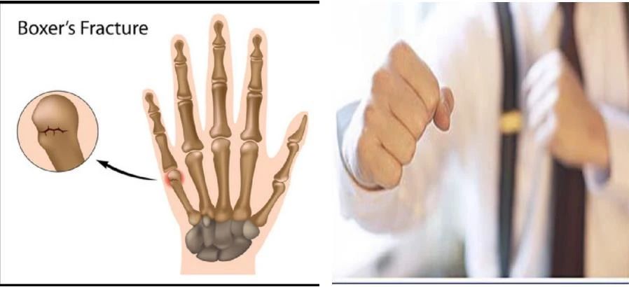 5 способов лечения перелома шейки пятой пястной кости