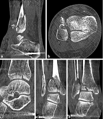 oldanklefracture03.jpg