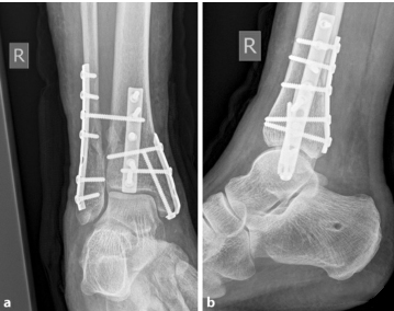 oldanklefracture09.jpg