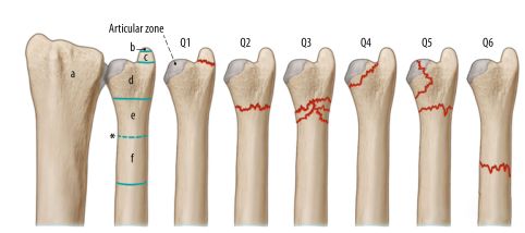 1700537990179841.png Surgical treatment of distal ulnar fractures01.png