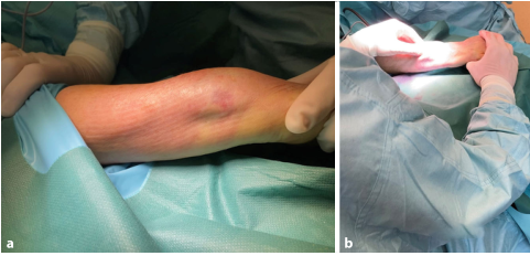 1700538126191289.png Surgical treatment of distal ulnar fractures02.png