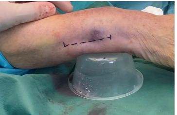 1700538221849263.png Surgical treatment of distal ulnar fractures03.png