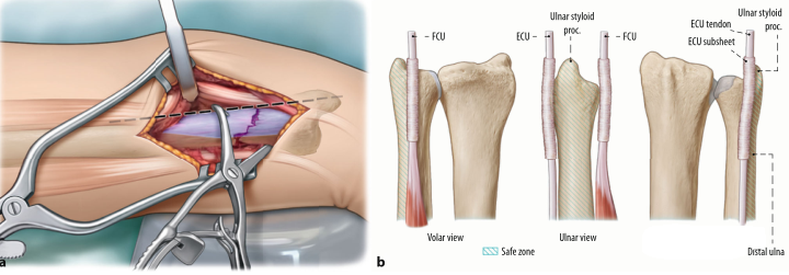 1700538413193613.png Surgical treatment of distal ulnar fractures06.png