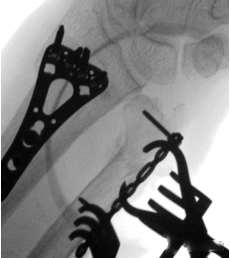 1700538480922105.png Surgical treatment of distal ulnar fractures08.png
