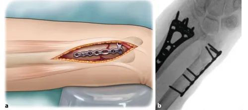 1700538525774164.jpg Surgical treatment of distal ulnar fractures09.jpg