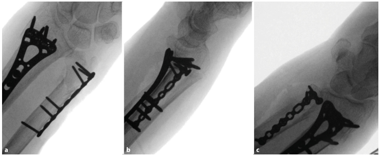 1700538587262094.png Surgical treatment of distal ulnar fractures010.png