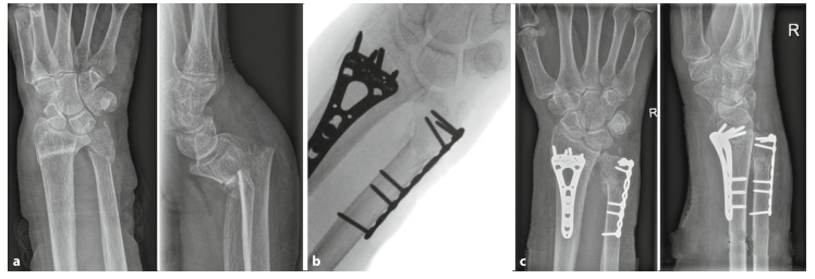 Surgical treatment of distal ulnar fractures011.png