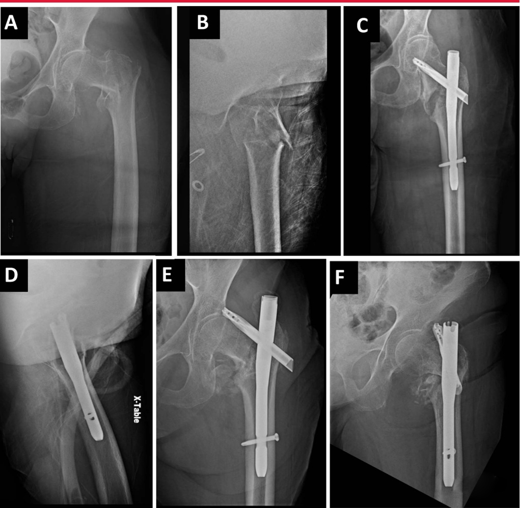Интрамедуллярное лечение межвертельного перелома бедренной кости – 8 аспектов оптимизации интрамедул
