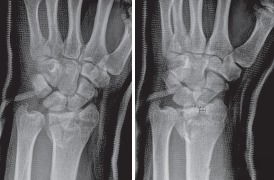 «Золотой стандарт» хирургии: внутренняя фиксация ладонной блокирующей пластиной подхода Генри для ле